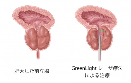 肥大した前立腺